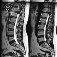 MRI lumbar hernia giant T12-L1