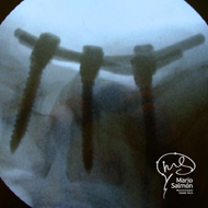 Intraoperative radiograph instrumentation L4-L5-S1