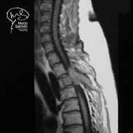 MRI Column shows tumor in T3