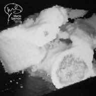 Tomography dislocation L5-S1