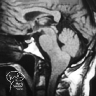 MRI of skull with tumor in spinal bulb