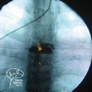 Transoperative Front X-ray, shown the cement in the vertebra