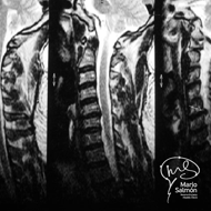 MRI Spine Cervical herniated disc C5-C6