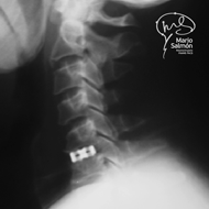 Postoperative control with Interbody box X-ray