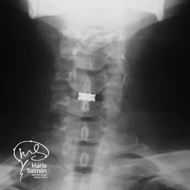 Postoperative control of front AP with Interbody box X-ray