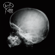 Lateral skull linear fracture X-ray