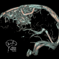 Arteriovenous malformation (angioresonance)