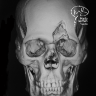 Cranial trauma