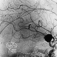 Cerebral Aneurysm (Digital subtraction angiography)